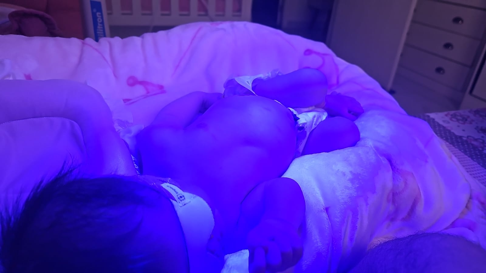 Todo Bebê Amarelo Precisa de Fototerapia? Entenda Quando o Tratamento é Necessário