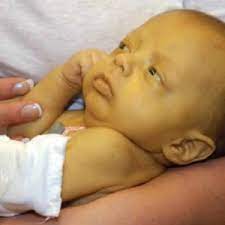 O que é a icterícia neonatal?