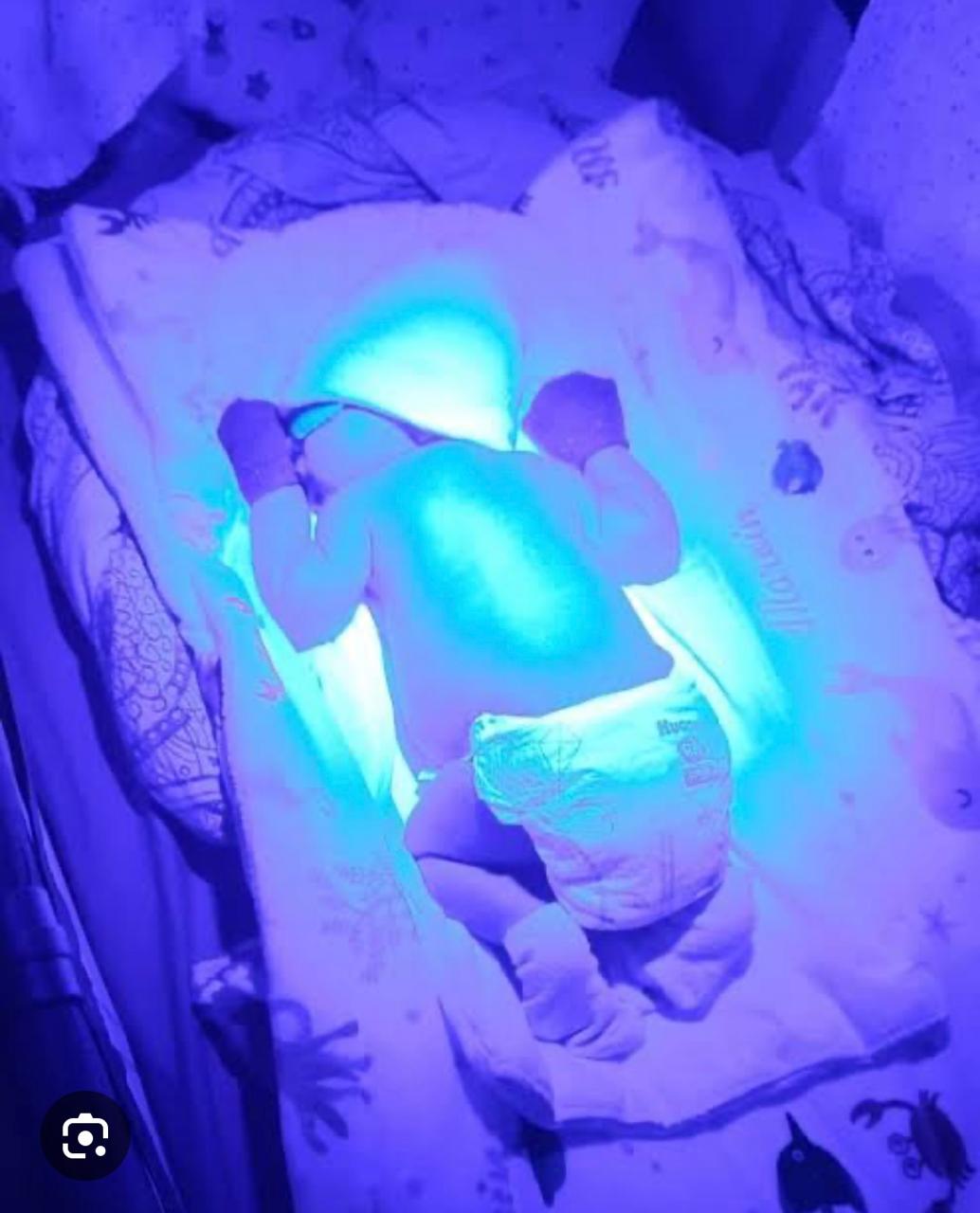O que faz proteção Ocular do Bebê na Fototerapia Neonatal