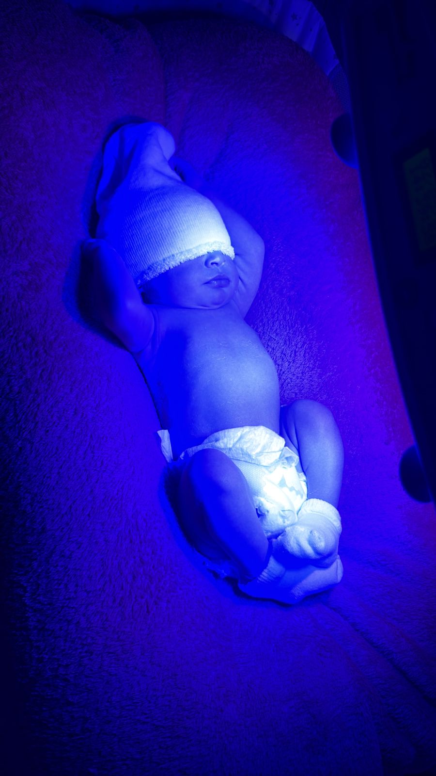 Icterícia Neonatal em Ubatuba: Evite a Internação com Banho de Luz em Casa