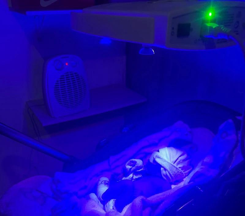 Fototerapia Neonatal em São Bernardo do Campo: Trate a Icterícia em Casa